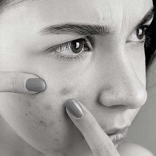 Content image for Dealing with Persistent Breakouts? Understanding Acne Triggers.