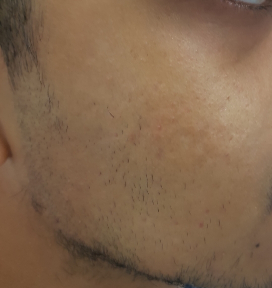 Featured image for Frustrated by Acne Scars That Won't Fade? Effective Treatments.