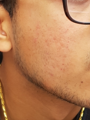 Content image for Frustrated by Acne Scars That Won't Fade? Effective Treatments.