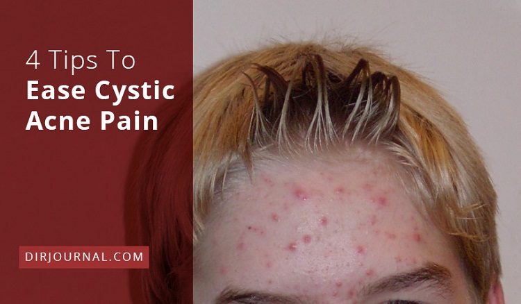 Featured image for Cystic Acne Pain and Inflammation? Soothing Solutions.
