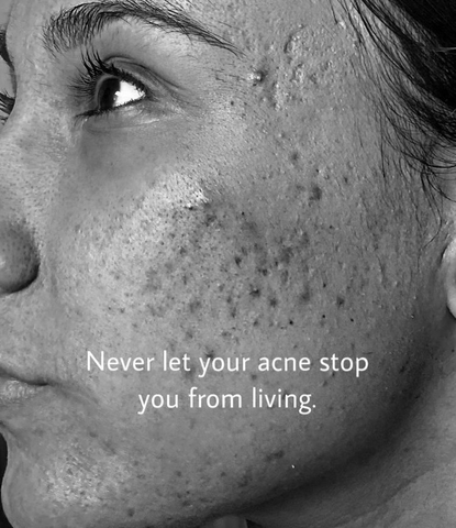 Content image for Boosting Your Confidence While Battling Acne? Practical Advice.