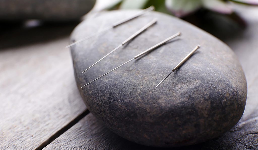 Content image for Fear of Needles Preventing Your Acupuncture Treatment? Understanding the Process.