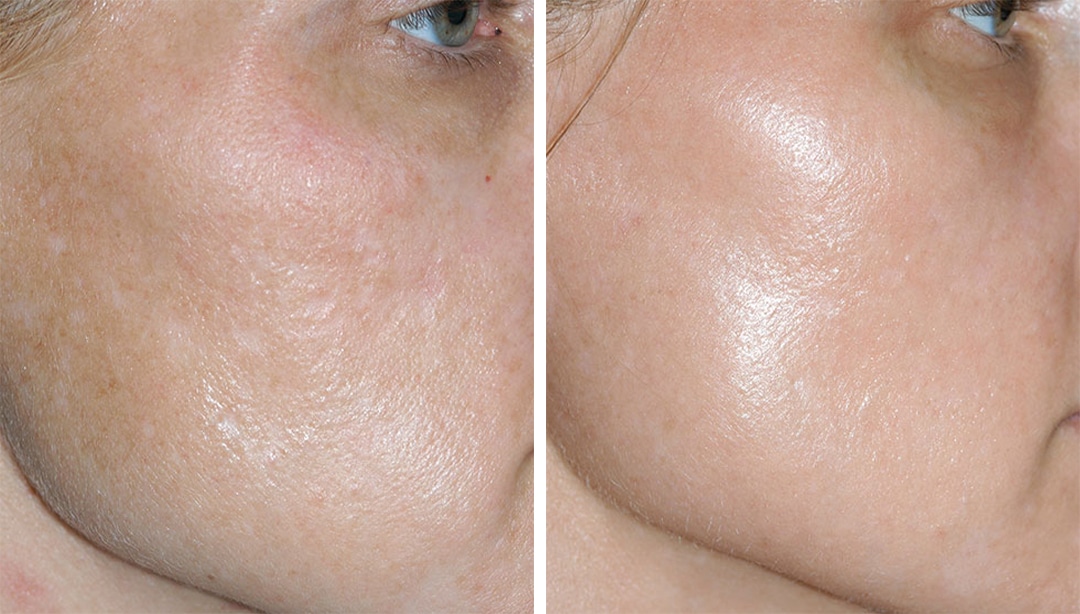 Featured image for Skin Deep: Tackling Age Spots and Texture Changes Effectively