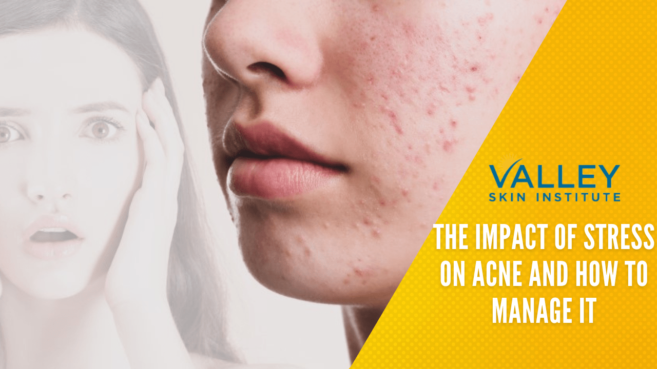 Featured image for The Impact of Stress on Skin Conditions Like Acne and Eczema