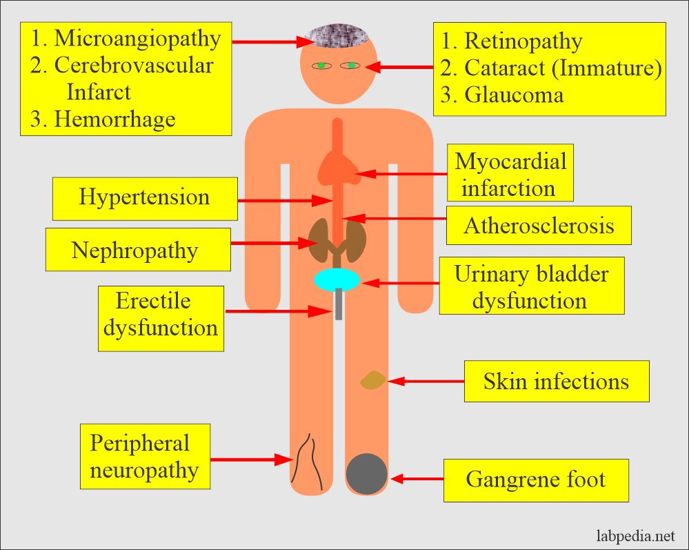 Content image for Understanding Complications Arising from Poor Diabetes Management