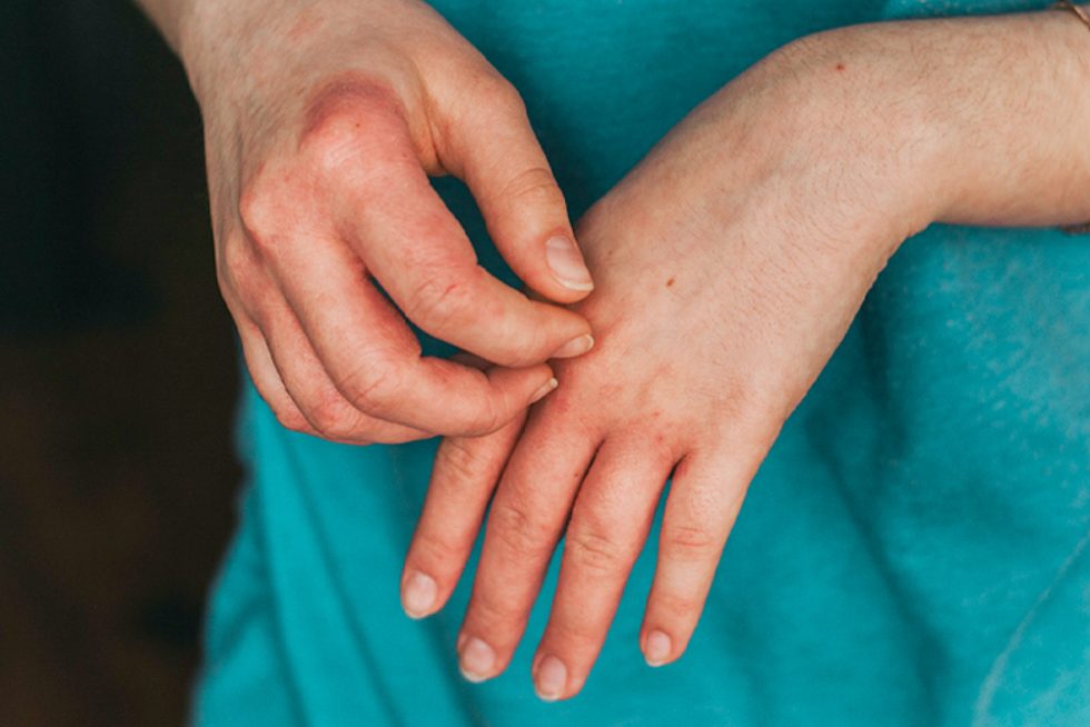Featured image for How Environmental Triggers Worsen Eczema Flare-Ups Unexpectedly