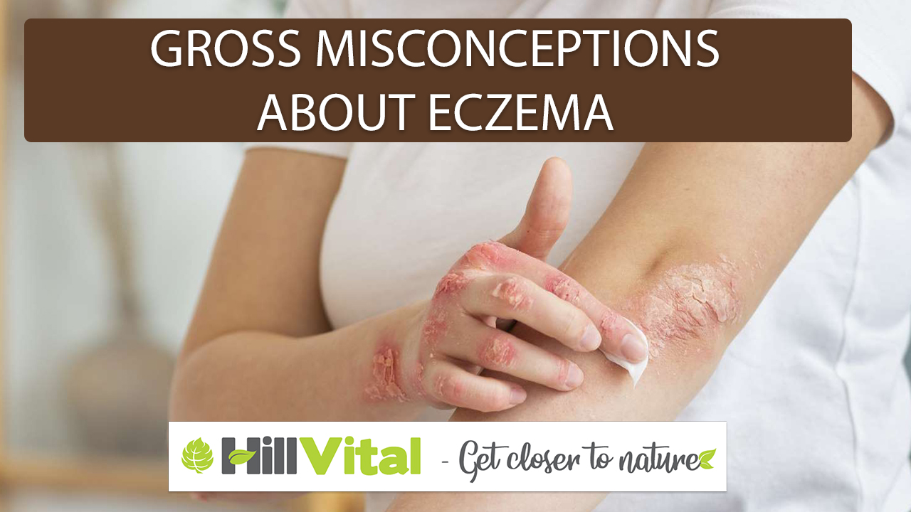 Featured image for Common Misconceptions About Eczema Treatment and Management