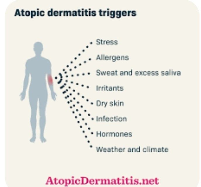 Featured image for Identifying Allergens That May Aggravate Your Eczema Condition