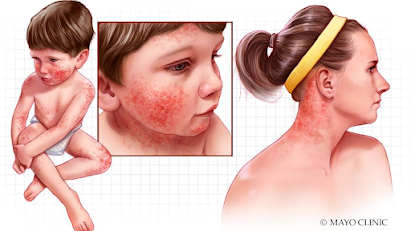 Content image for Effective Daily Habits to Reduce Eczema Irritation and Discomfort