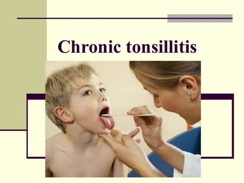 Featured image for Effective Treatments for Chronic Tonsillitis and Throat Irritations
