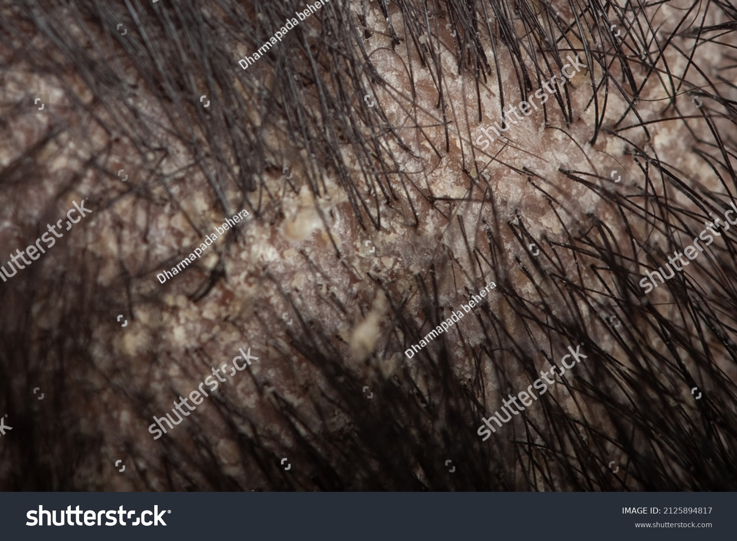 Featured image for The Impact of Nutrition Deficiencies on Scalp and Follicle Health