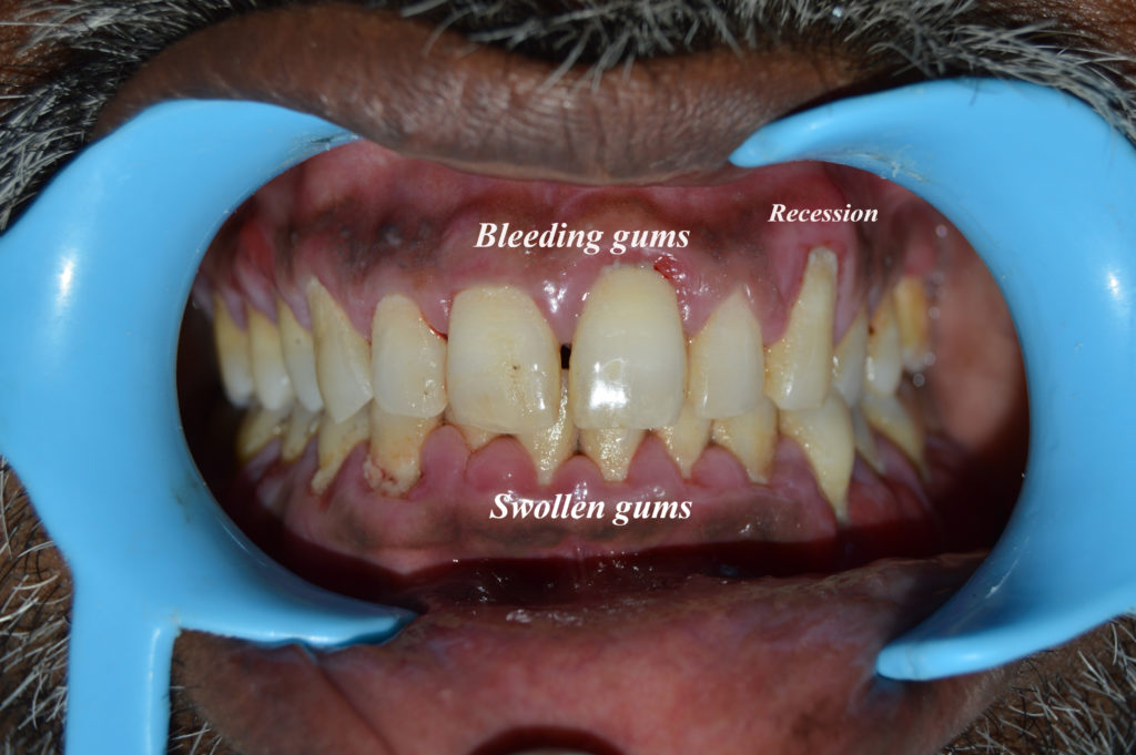 Content image for Early Detection Signs of Gum Disease and Infections